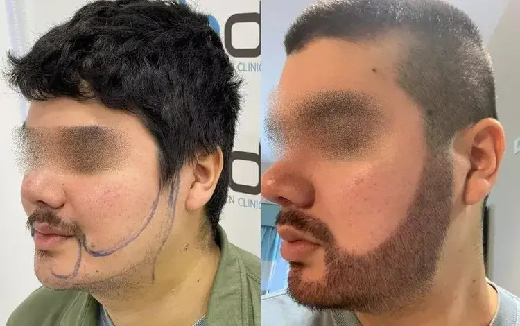 sakal ekiminde 10 günde kabuklar dökülür