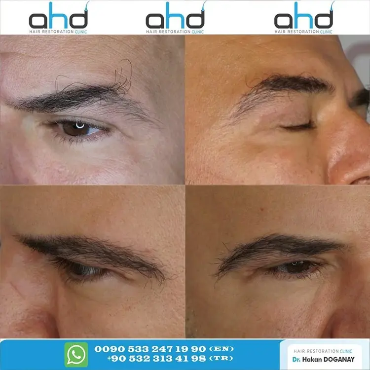 Imagen del antes y el después de un trasplante de cejas de un hombre