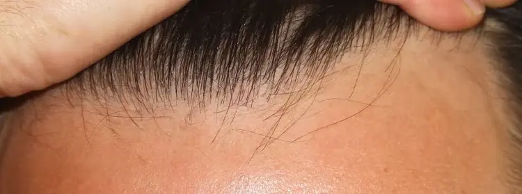Come dovrebbe essere l'attaccatura naturale dei capelli in un trapianto? La risposta è nell'immagine.