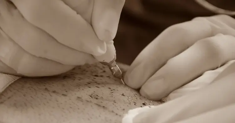 Borsthaartransplantatie
