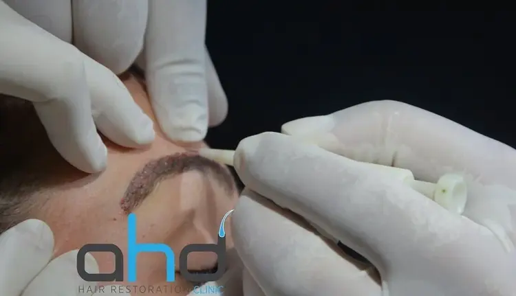 El método DHI de trasplante de cejas permite obtener resultados de aspecto natural.