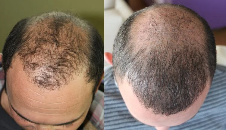 Un trasplante de cabello fallido y su imagen corregida.