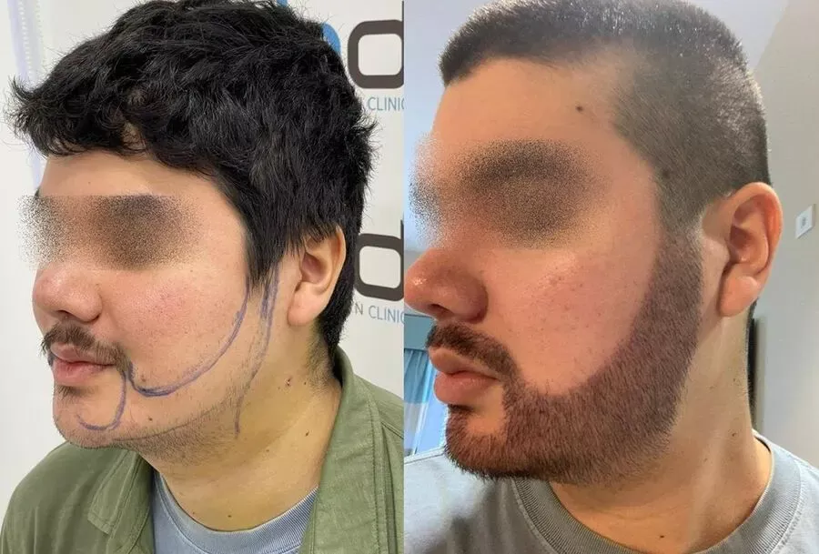 El décimo día del trasplante de barba para un hombre calvo