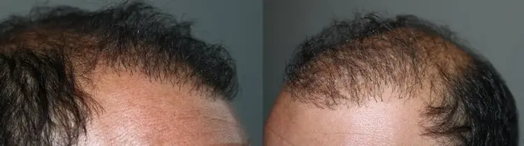 Un trapianto di capelli fallito: angoli errati, innesti multipli nella linea frontale e un aspetto rado