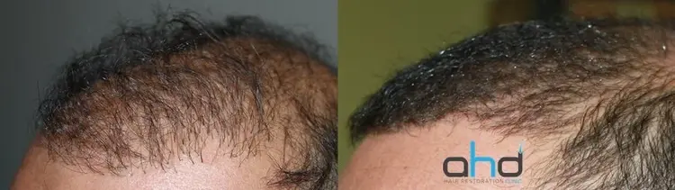 El trasplante de pelo arregla