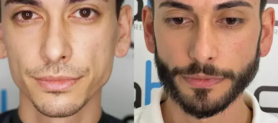 Prima e dopo il trapianto di barba