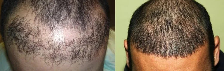 Capelli dall'aspetto naturale dopo un intervento correttivo per un trapianto fallito.