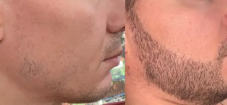 Resultado 4 meses após um transplante de barba