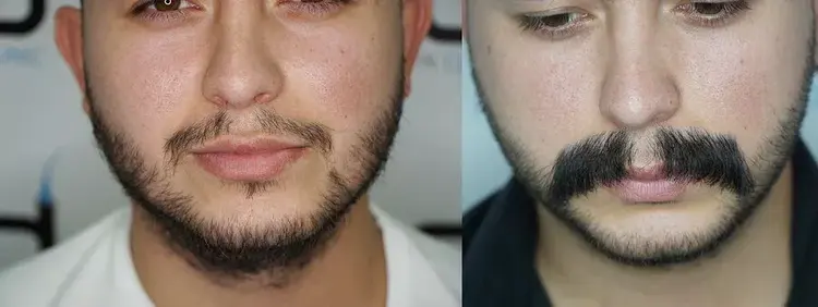 transplante de bigode antes e depois