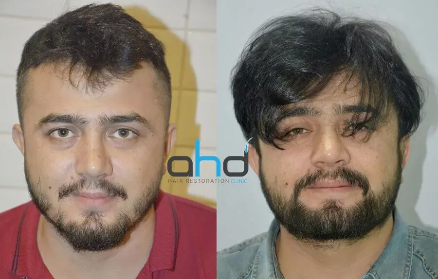 Guarda il fantastico risultato prima e dopo il trapianto di barba, capelli e baffi
