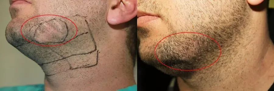 Trapianto di barba per coprire una cicatrice sulla guancia