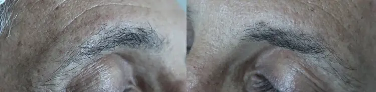 Trasplante de ceja en cicatriz