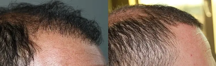 Cómo mejorar una línea de cabello dañada
