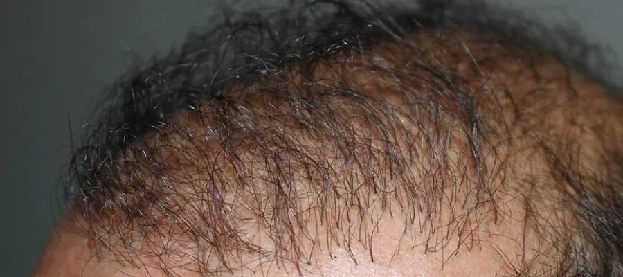 bad hair transplant