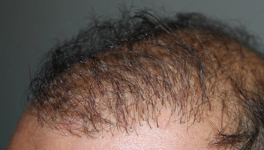 bad hair transplant picture