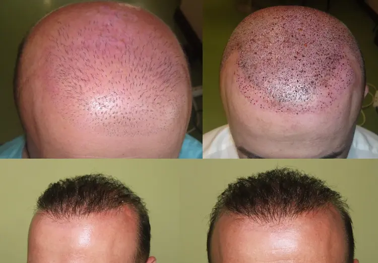 Hoe repareer je een slecht uiterlijk bij een haartransplantatie? Het antwoord staat in de afbeelding.