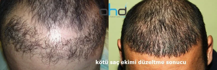 başarısız saç ekimini düzeltme