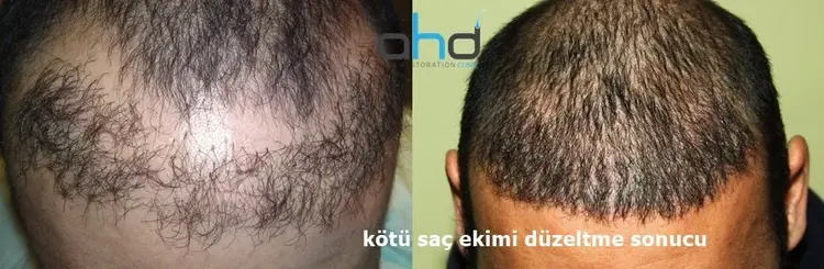 başarısız saç ekimi ve onarım sonucundaki doğal görüntüsü (düzeltme işlemi)