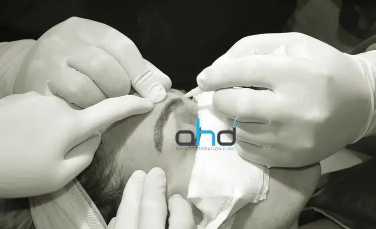 Wenkbrauwtransplantatie met de DHI-methode