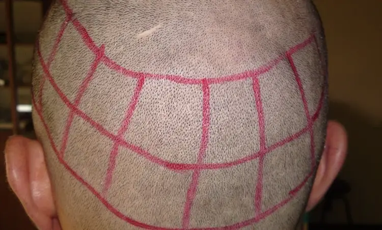 donorgewicht voor haartransplantatie (haar aan de achterkant van het hoofd)