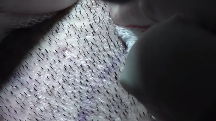 Bij haartransplantatie worden grafts verzameld met de FUE-methode