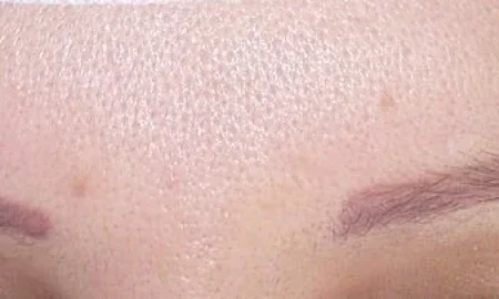 eyebrow transplant