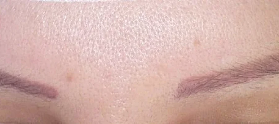 eyebrow transplant