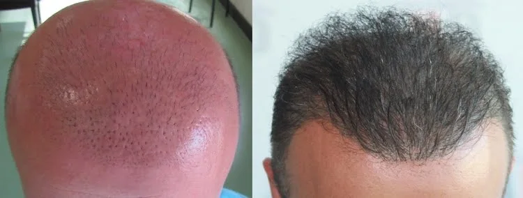 Uiterlijk ontsierd door een mislukte haartransplantatie - natuurlijk resultaat na correctie