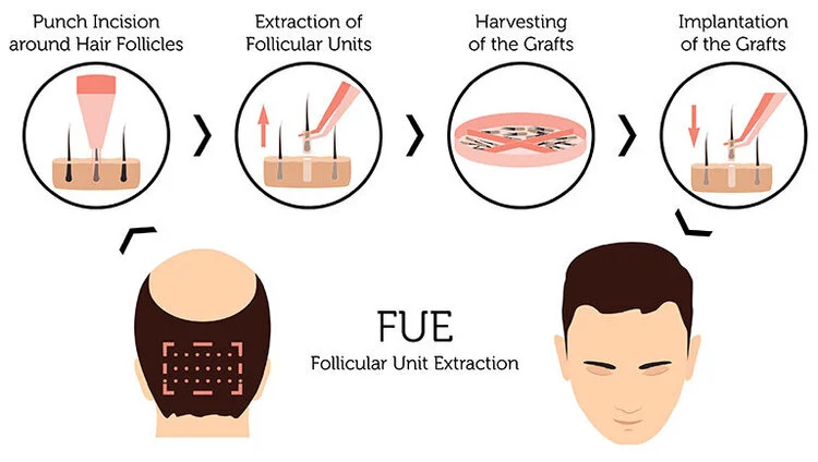 fue methode haartransplantatie