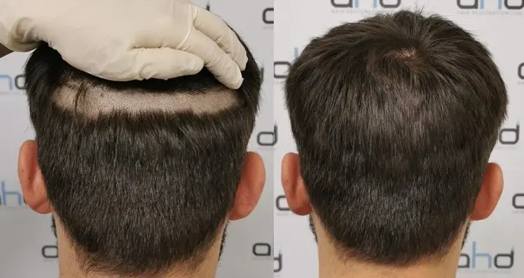 fue haartransplantatie zonder scheren