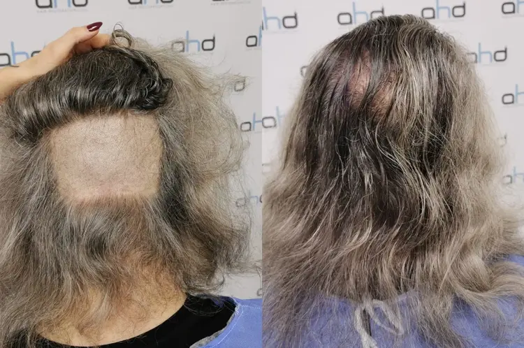 Chez les hommes aux cheveux longs, il est possible de réaliser une greffe de cheveux sans avoir à les couper.