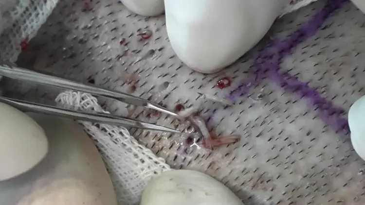Met de FUE-techniek worden de grafts één voor één uit het donorgebied verwijderd.