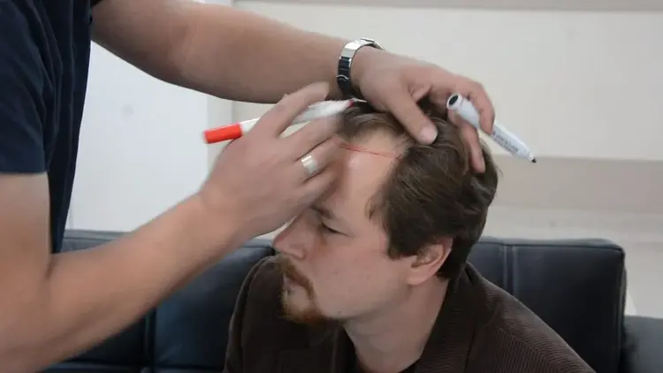 ontwerp van de haarlijn vóór haarimplantatie