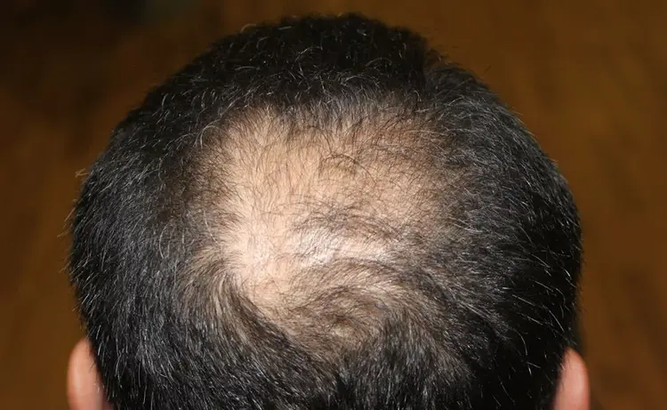 Haartransplantatie succespercentage kruin