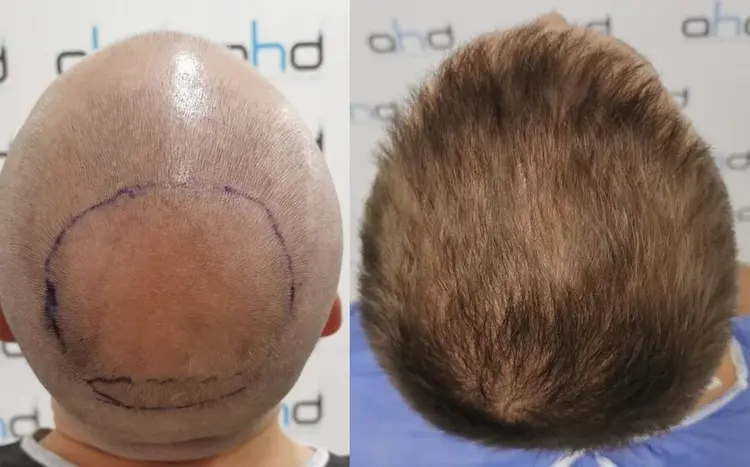 haartransplantatie kruin voor en na