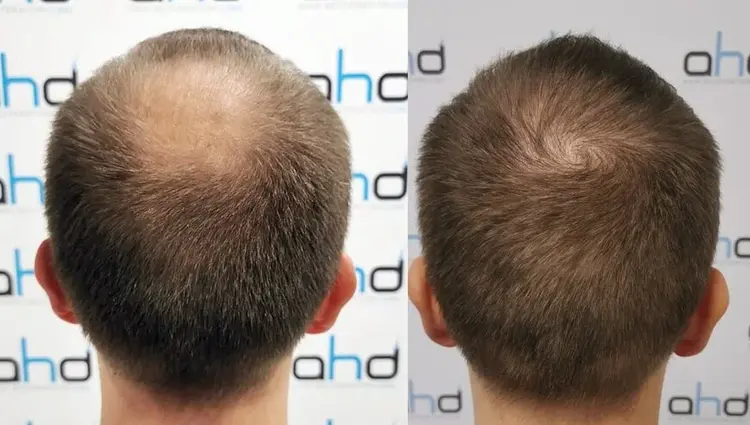 haartransplantatie kruin voor na
