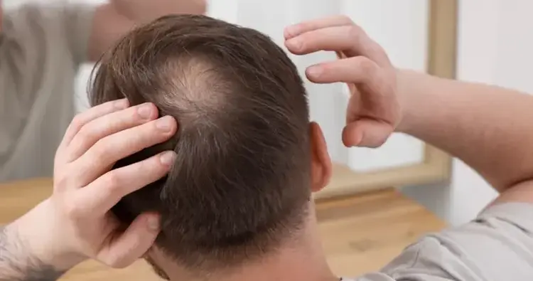 haartransplantatie kruin