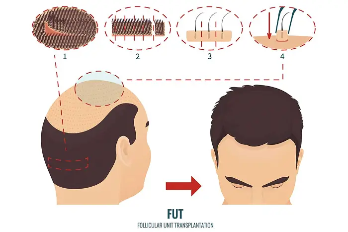haartransplantatie methoden