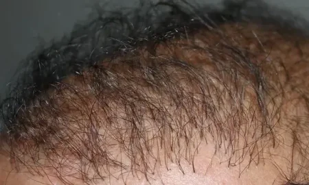 haartransplantatie mislukt