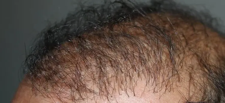 haartransplantatie mislukt