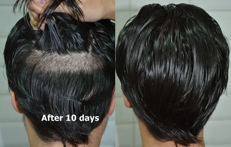 Ongeschoren haartransplantatie en 10 dagen later