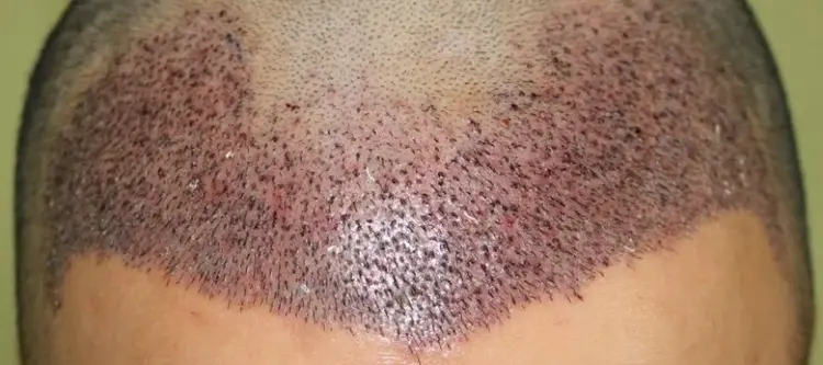 haartransplantatie
