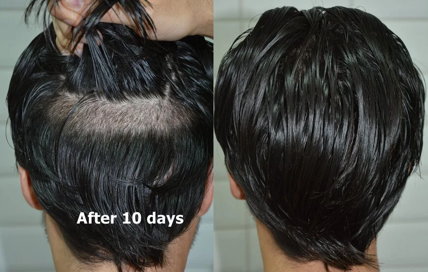 no shave hair transplantation