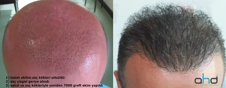 hatalı saç ekimi ve onarım işlemi