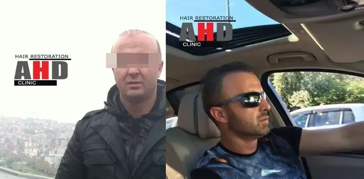 Slechte haartransplantatie- en revisieoperatieresultaten