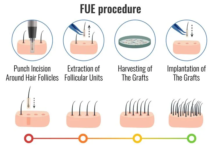 Follicular Unit Extraction