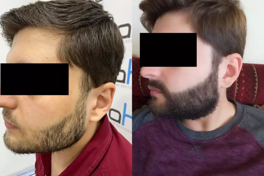 transplante de barba antes e depois