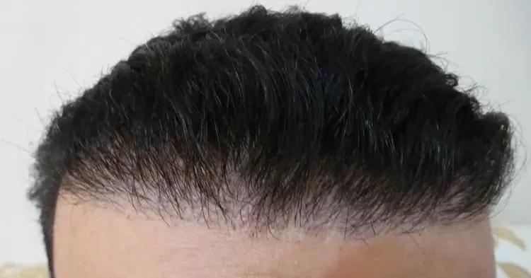 Una línea de cabello terrible y mala que se forma después de un trasplante de pelo