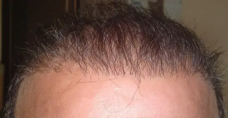 Ver un trasplante de cabello que resultó en un fracaso