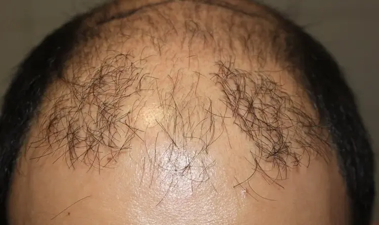 Het slechte resultaat van een mislukte haartransplantatie.